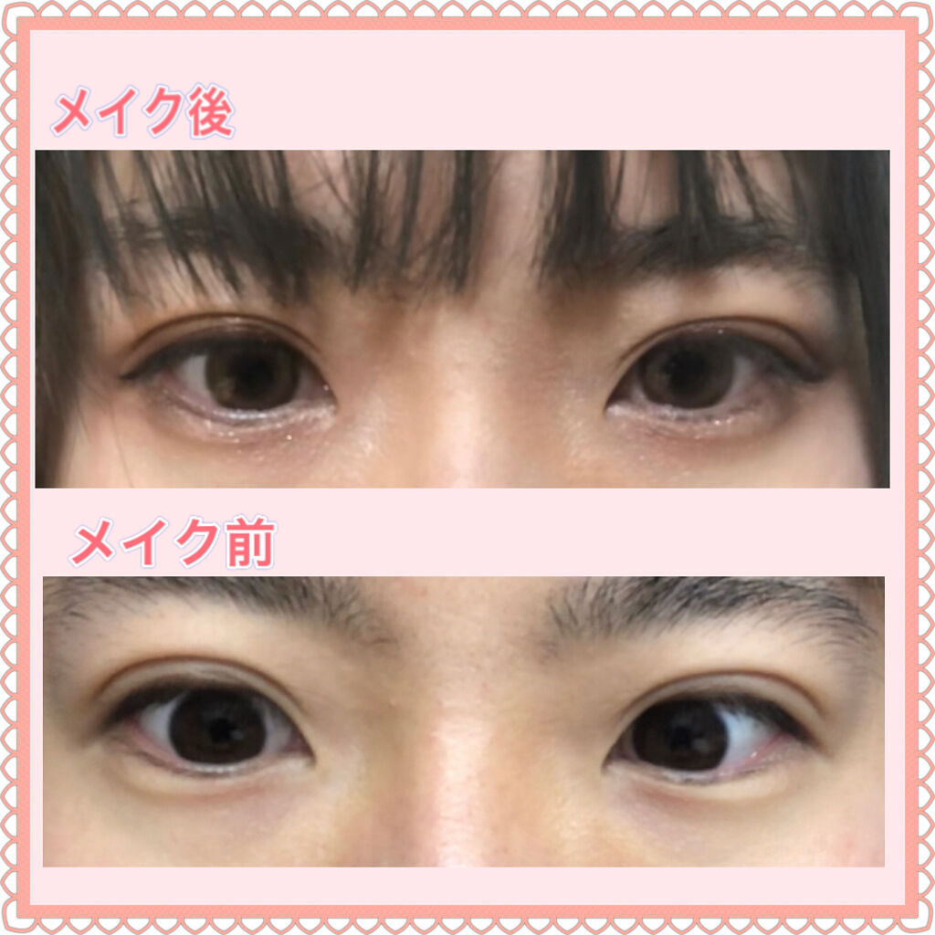 二重整形/その他を使ったクチコミ（2枚目）