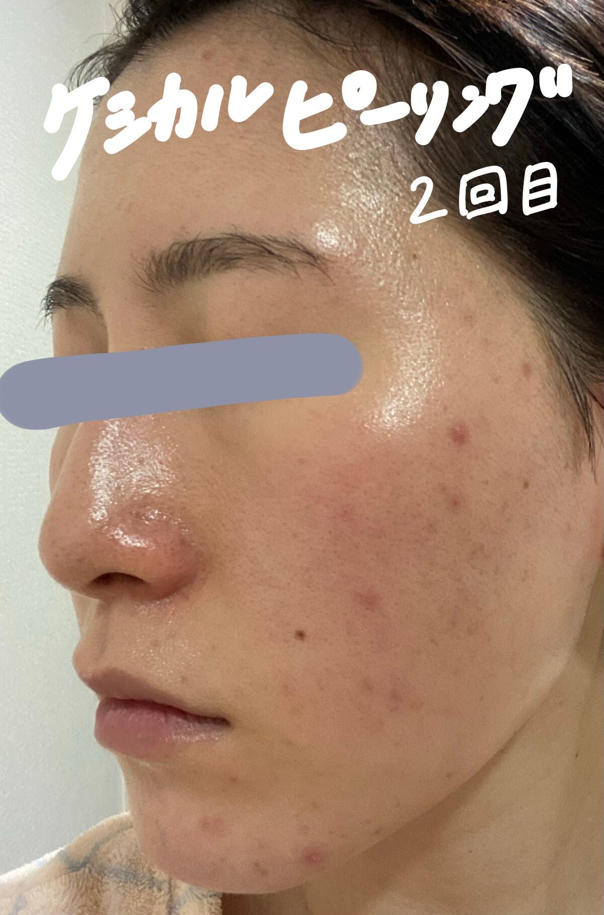 スキンピールバー ティートゥリー/サンソリット/洗顔石鹸を使ったクチコミ(5枚目)