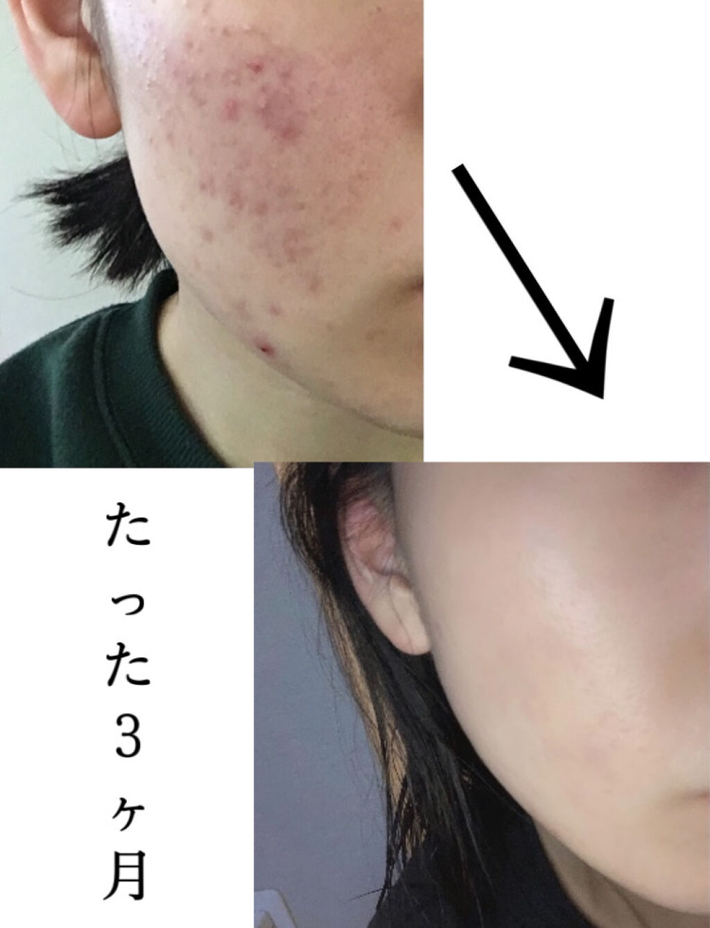 長柄カミソリ ビューティーM /貝印/シェーバーを使ったクチコミ（1枚目）