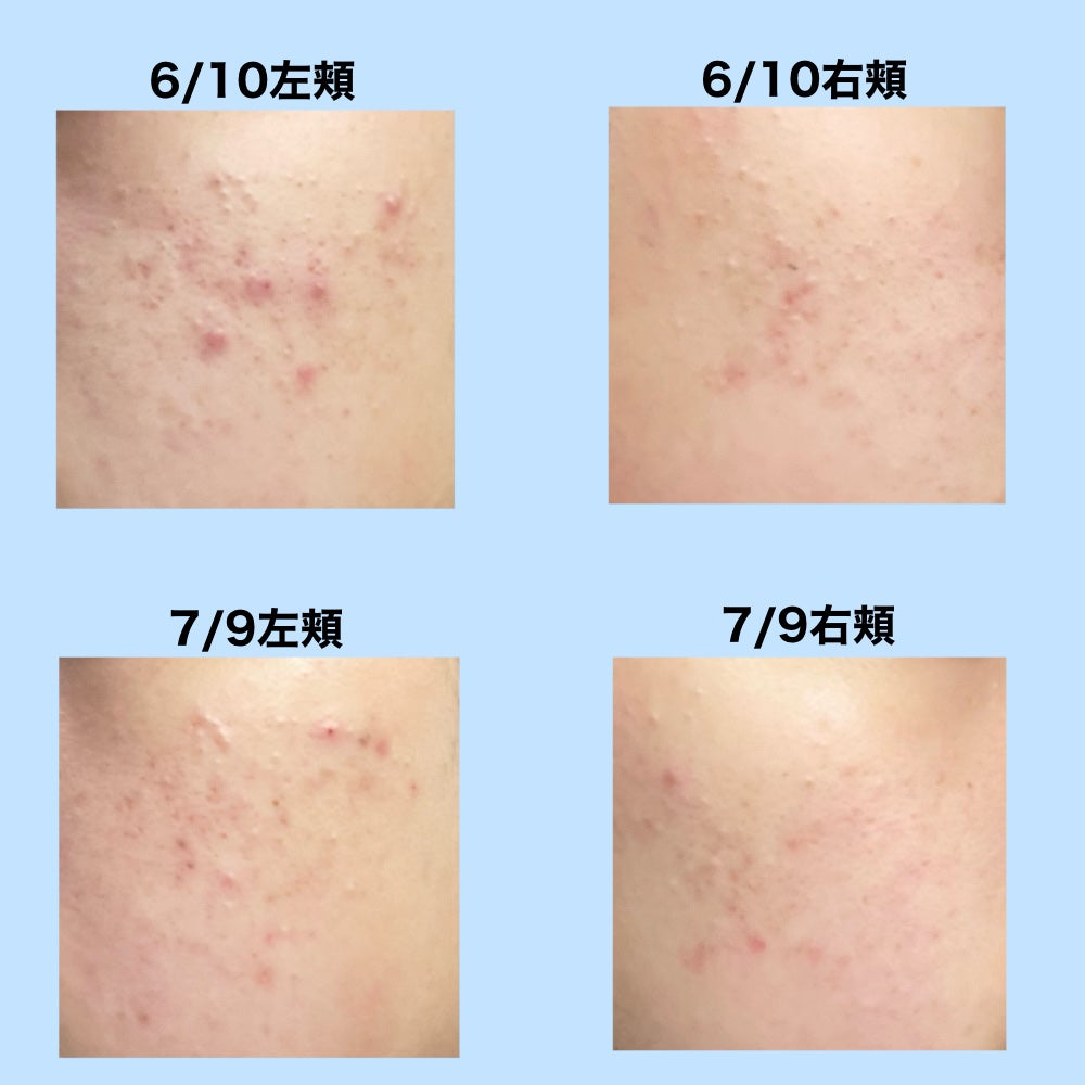 薬用 極潤 スキンコンディショナー/肌ラボ/化粧水を使ったクチコミ(2枚目)