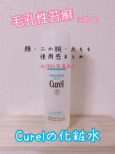 はじめまして。
毛孔性苔癬＆顔面毛包性紅斑黒皮症のンゴです🐣


❓毛孔性苔癬とは❓

明確な原因がハッキリしてない皮膚病です。
毛穴の出口に角質がたまり毛穴を塞いでしまいます。「鮫肌」とも呼ばれ主に二