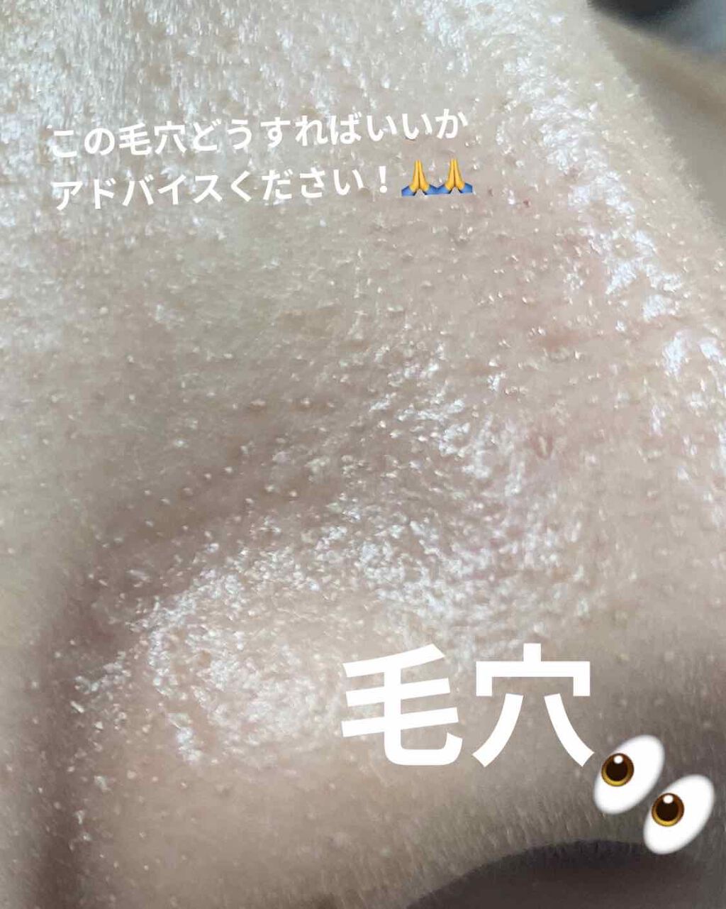 かりんとう👸🏼 on LIPS 「ずっと毛穴で悩んでいます😱この毛穴をなくす方法を教えてくださる..」(1枚目)