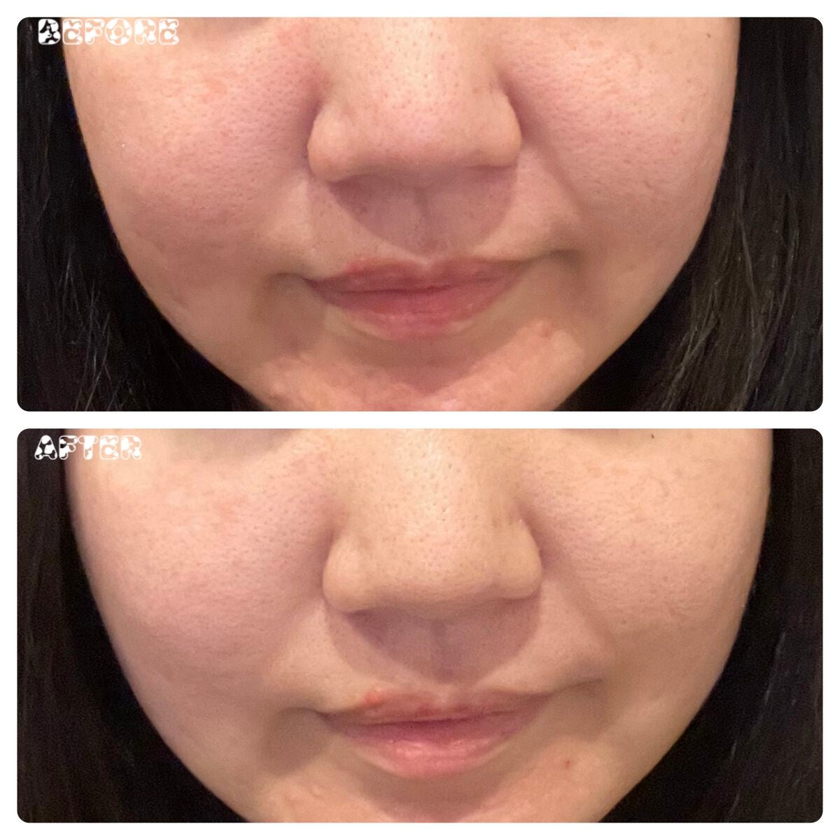 アカルミー セラム/ワイズ製薬/美容液を使ったクチコミ(3枚目)