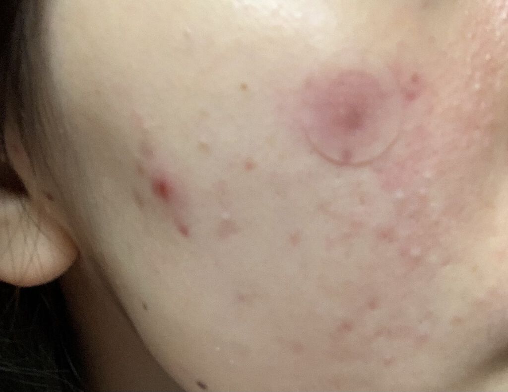 潤浸保湿 化粧水 II しっとり/キュレル/化粧水を使ったクチコミ（2枚目）