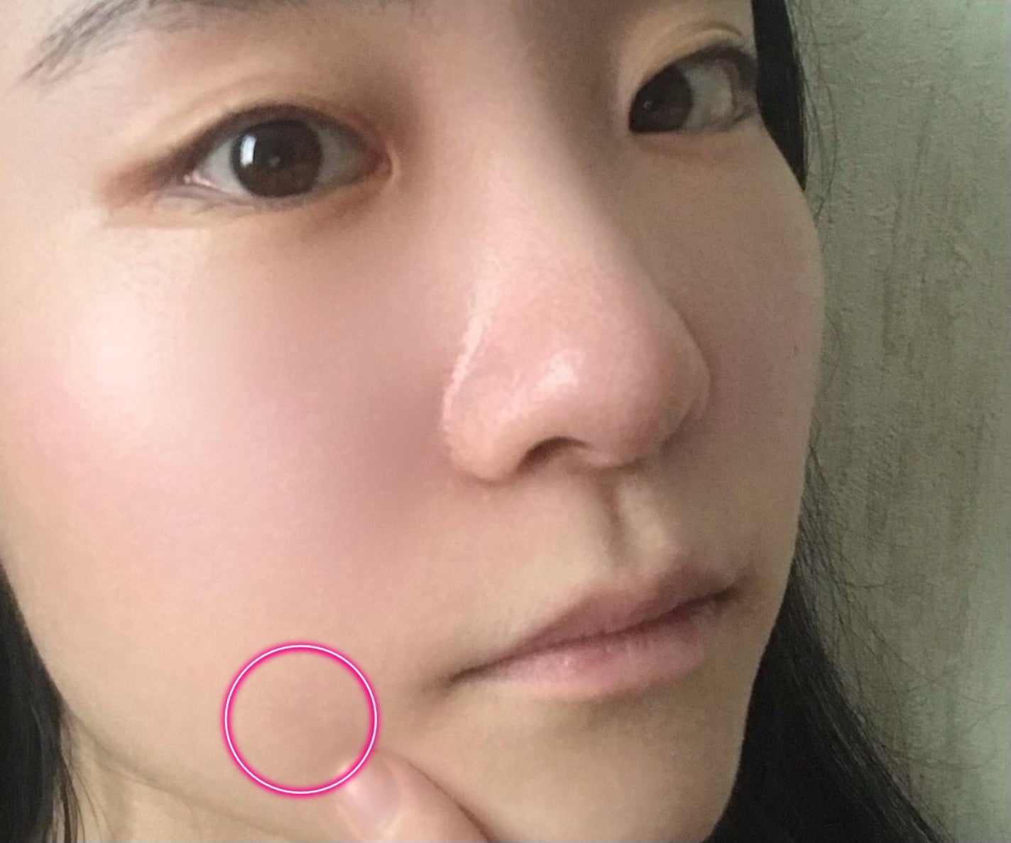 極薄透明パッチ nikipa!/金冠堂/にきびパッチを使ったクチコミ(3枚目)