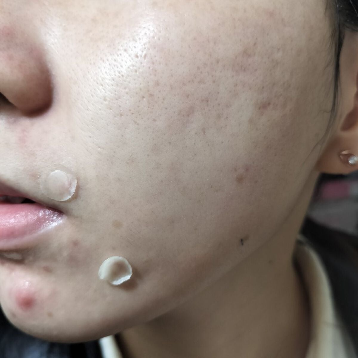 オロナインH軟膏 (医薬品)/オロナイン/その他を使ったクチコミ(2枚目)