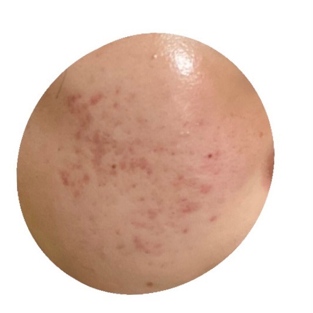 pink_sounds_dlm on LIPS 「前の投稿と比べたらだいぶニキビ跡薄くなったけど、ここからなにを..」(1枚目)