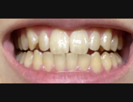 TEETH WHITENING STRIPS/3D WHITE/その他オーラルケアを使ったクチコミ(3枚目)