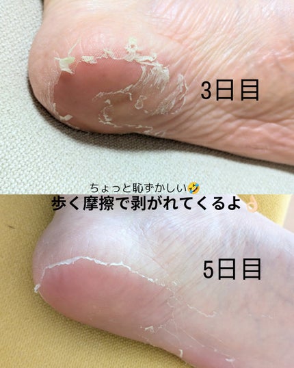 イージーパックDP60分タイプ/ベビーフット/レッグ・フットケアを使ったクチコミ(3枚目)