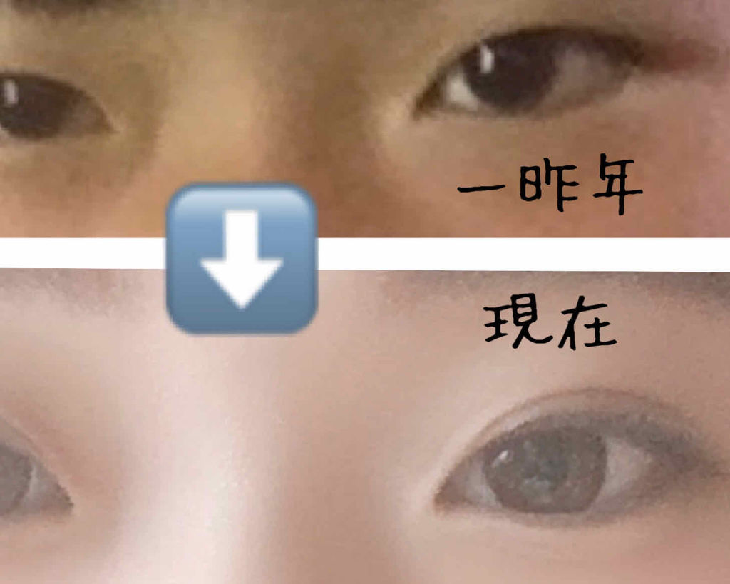 のびーるアイテープ（絆創膏タイプ、レギュラー）/DAISO/二重まぶた用アイテムを使ったクチコミ（2枚目）