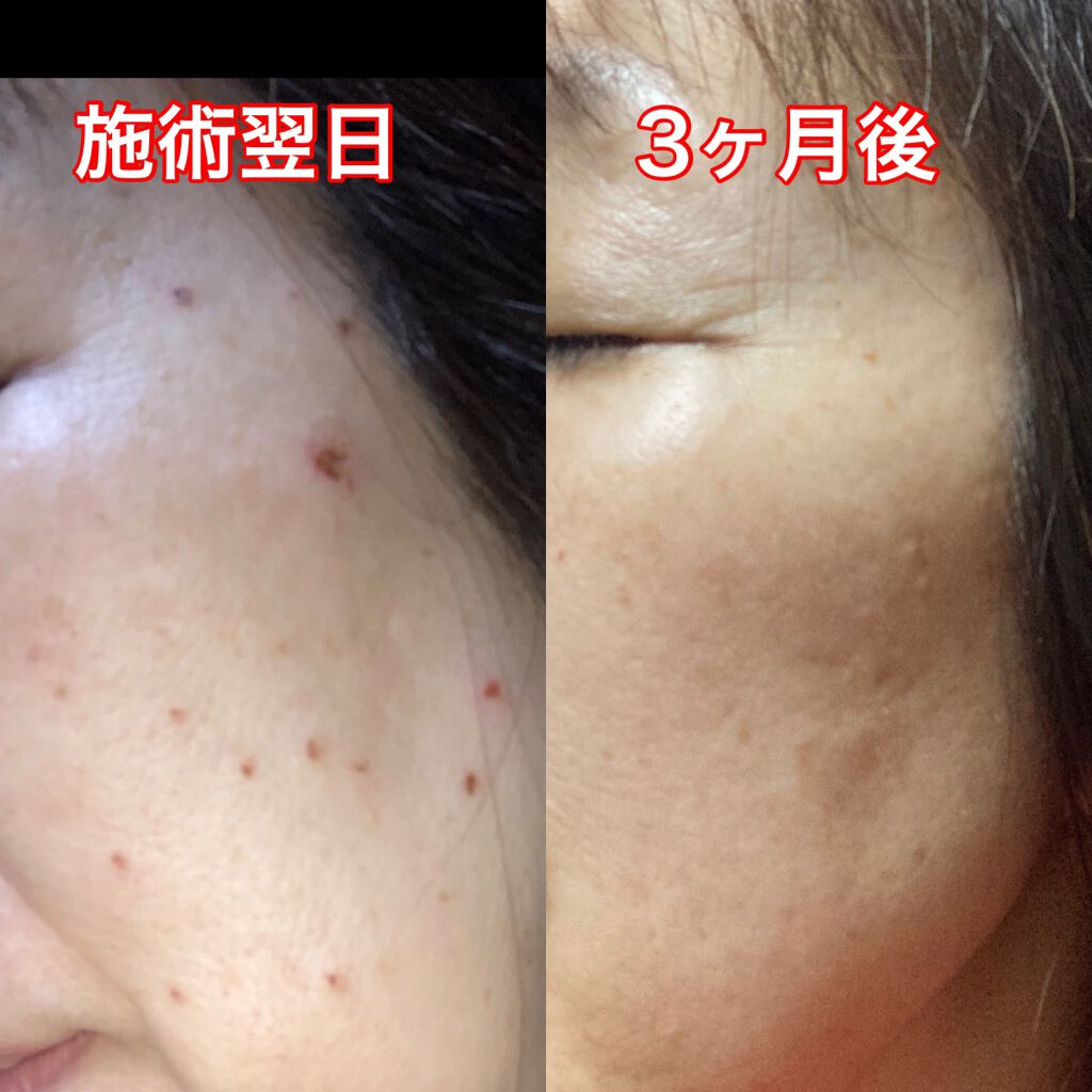 ネイチャーコンク 薬用クリアローション/ネイチャーコンク/拭き取り化粧水を使ったクチコミ（2枚目）