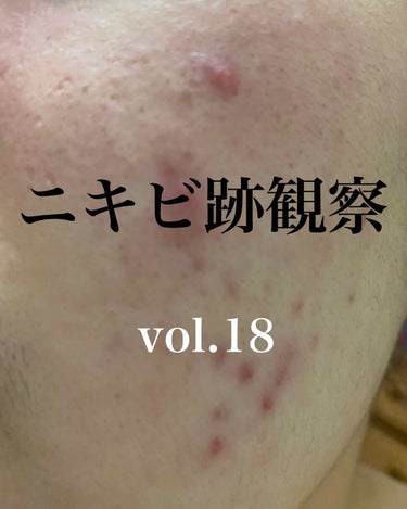 無印良品 敏感肌用薬用美白美容液のクチコミ「タイトル変えました！

ニキビも悩んではいるのですが...😢

改めて私の肌はニキビ跡だらけで.....」（1枚目）