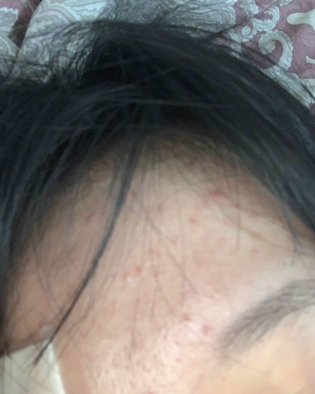 あああ on LIPS 「ほんとにニキビが治らない。もうすっごいしんどい。なんかいい方法..」(2枚目)