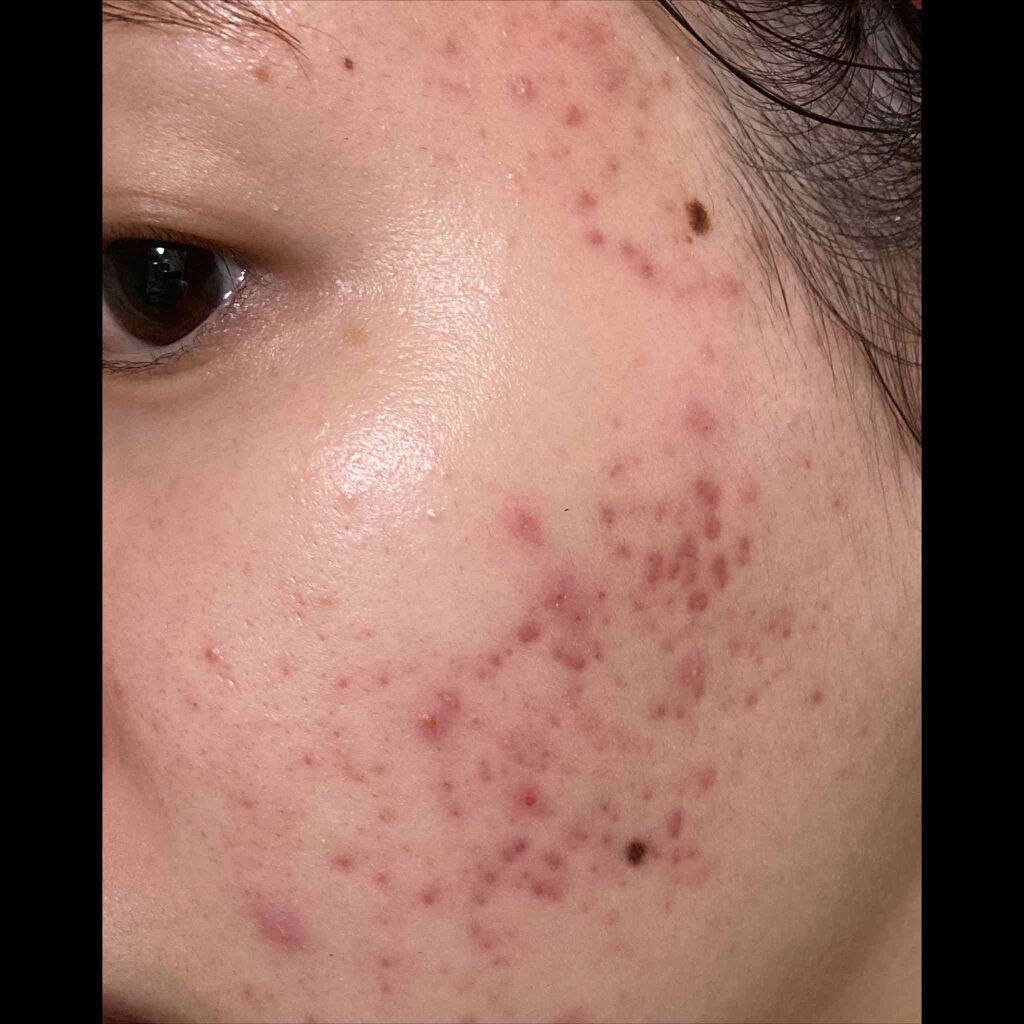 ディフェリンゲル0.1% /マルホ株式会社/その他を使ったクチコミ（1枚目）