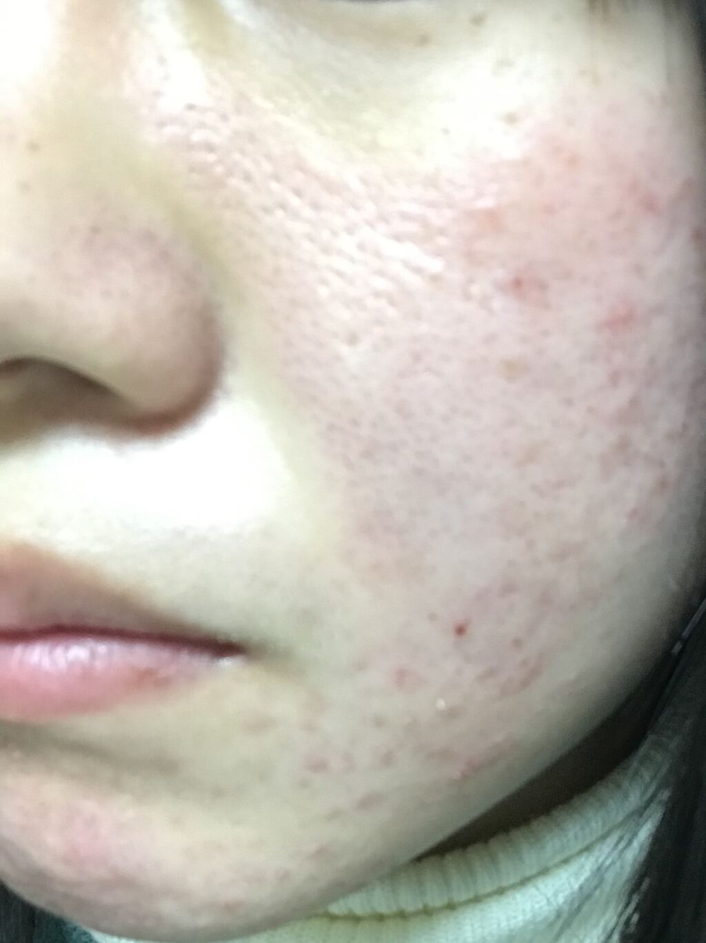 エピデュオゲル/マルホ株式会社/その他を使ったクチコミ（2枚目）