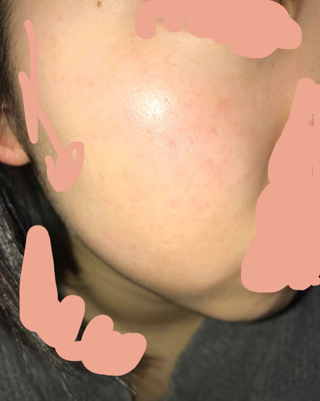 ベピオゲル/マルホ株式会社/その他を使ったクチコミ（2枚目）