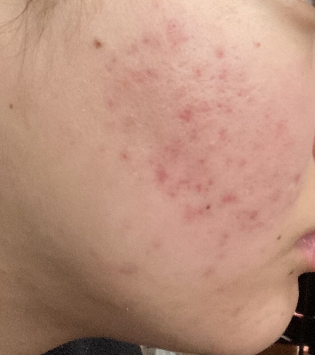 クリンダマイシンゲル(医薬品)/クラシエ薬品/その他を使ったクチコミ（1枚目）