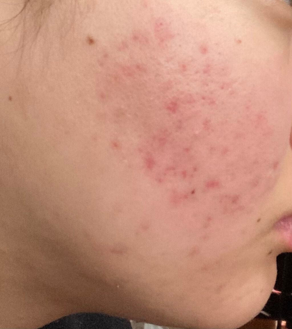 とろり on LIPS 「本格的なニキビ生活から本格的なニキビ跡生活にシフトしました。い..」(1枚目)