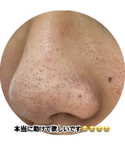 クラリファイング ローション 2/CLINIQUE/拭き取り化粧水を使ったクチコミ(3枚目)