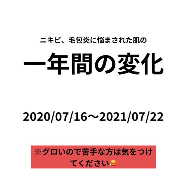 ジョンソン・エンド・ジョンソン テラ・コートリル 軟膏(医薬品)のクチコミ「今も汚いですが、変わってはいるということが唯一のモチベです😓

正直薬は即効性が無く、時間が解.....」（1枚目）