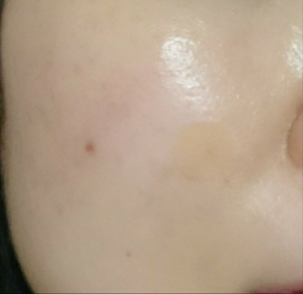 Nexcare/3M nexcare/にきびパッチを使ったクチコミ(1枚目)