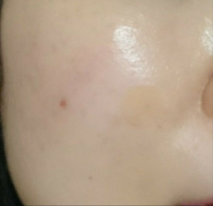 Nexcare/3M nexcare/にきびパッチを使ったクチコミ(1枚目)