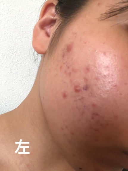 チョコラBBプラス (医薬品)/チョコラBB/その他を使ったクチコミ(4枚目)