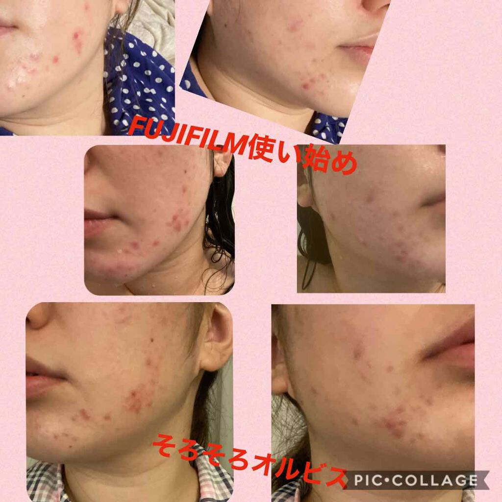 薬用 クリアローション M(しっとりタイプ)/オルビス/化粧水を使ったクチコミ（1枚目）