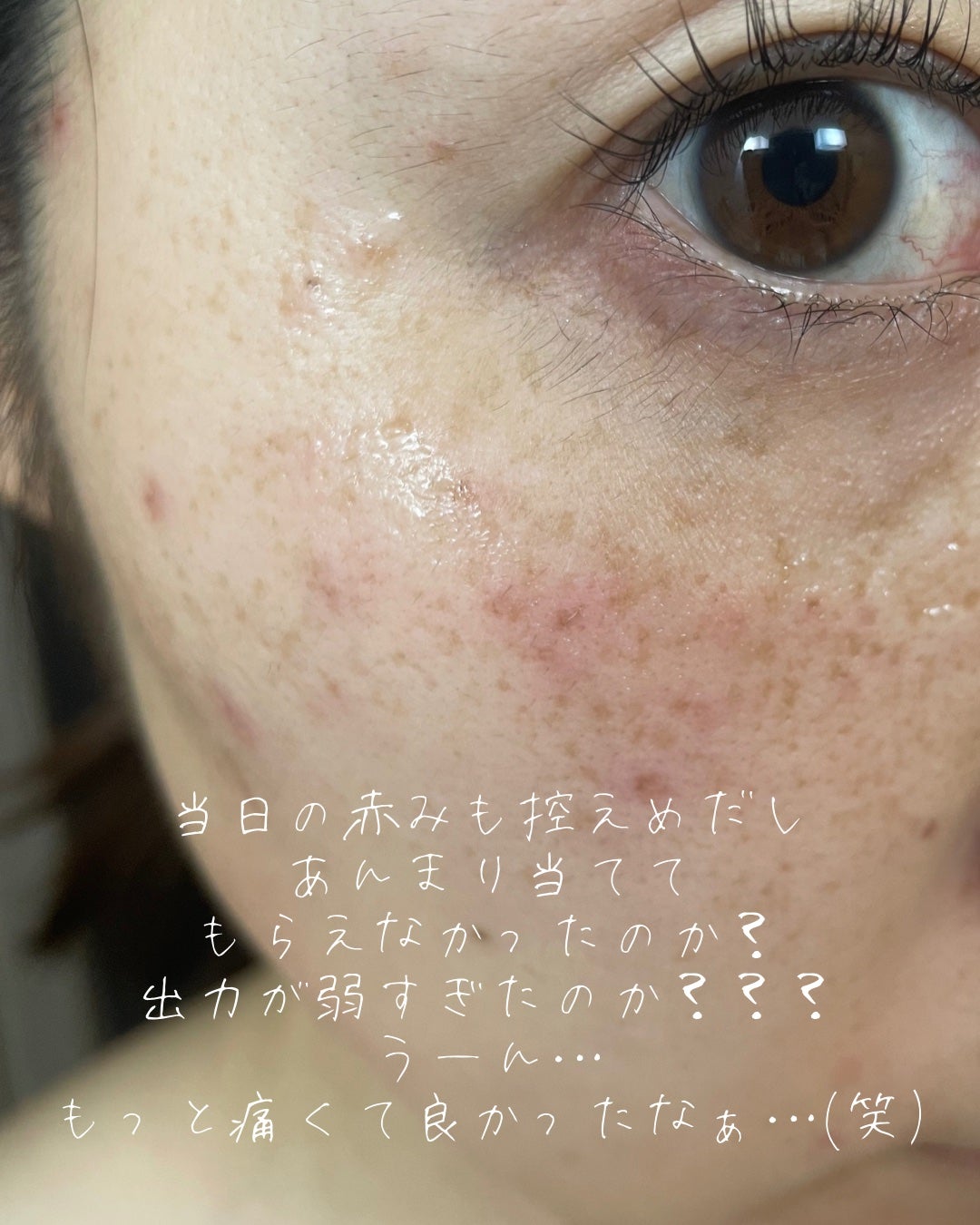 ããðª on LIPS ããã³ã¹ãããã®èšé²âïžðããããããã³ã¬ãŒã¶ãŒããšã¯ãã³ç§ïŒ1..ãïŒ6æç®ïŒ