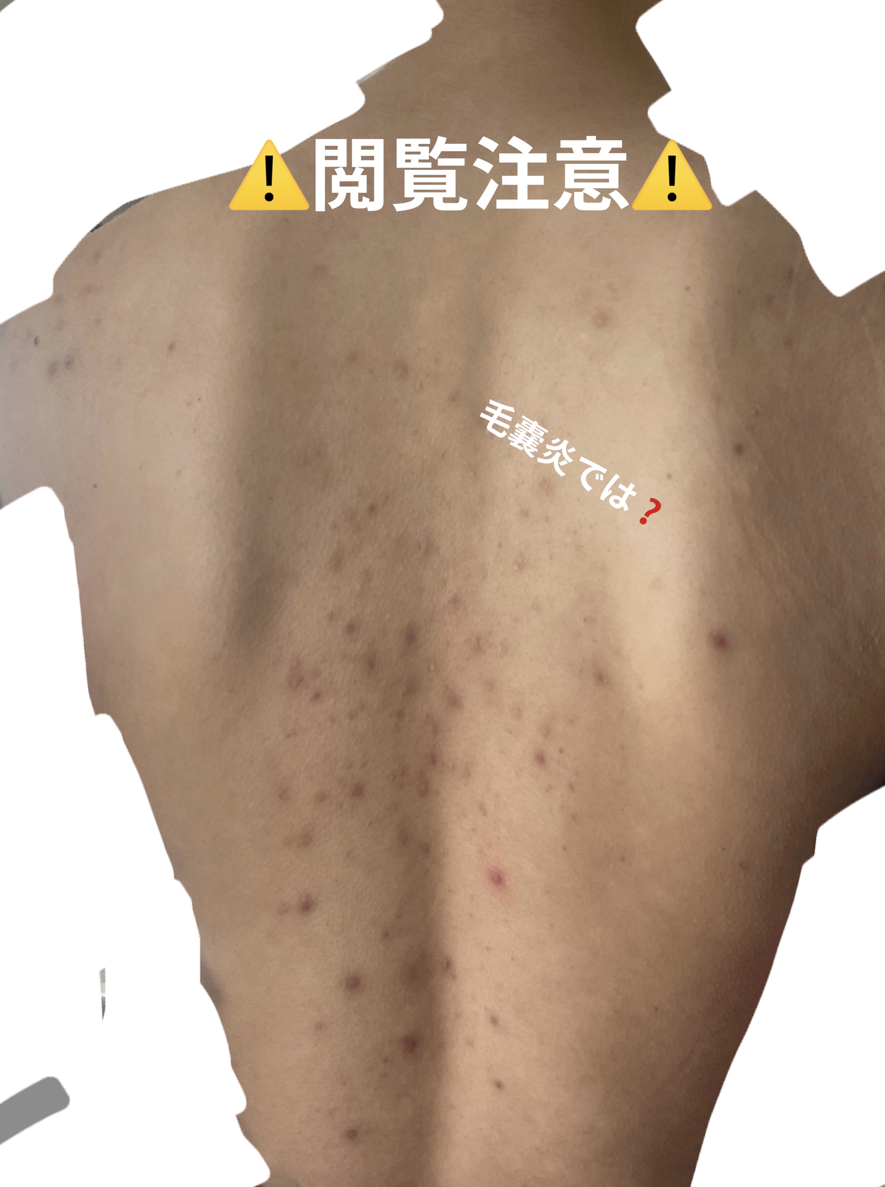 クロマイ-N軟膏（医薬品）/第一三共ヘルスケア/その他を使ったクチコミ（2枚目）