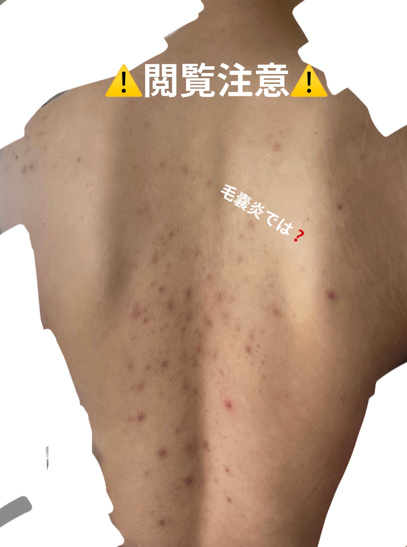 クロマイ-N軟膏(医薬品)/第一三共ヘルスケア/その他を使ったクチコミ(2枚目)