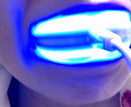 Dr.USB ホワイトニング専用LEDライト/WHITE CLUB/その他オーラルケアを使ったクチコミ(6枚目)