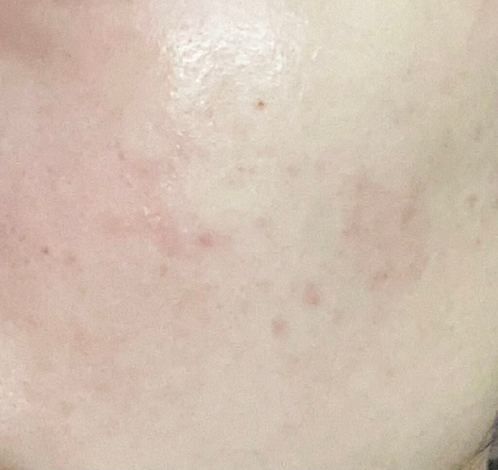 fresh_rouge_fe3j4iaj on LIPS 「皮膚科のお薬をつかって1週間と3日が経ちました😀新しいニキビは..」(2枚目)