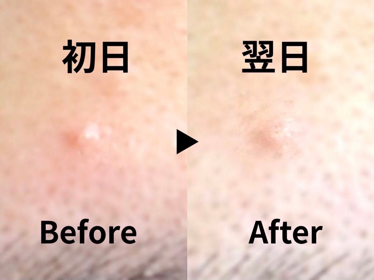 ミラクルアクネクリアスポットトリートメント/SOME BY MI/美容液を使ったクチコミ(6枚目)