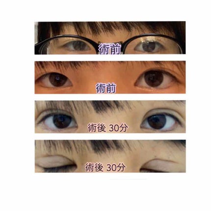二重整形/その他を使ったクチコミ(1枚目)