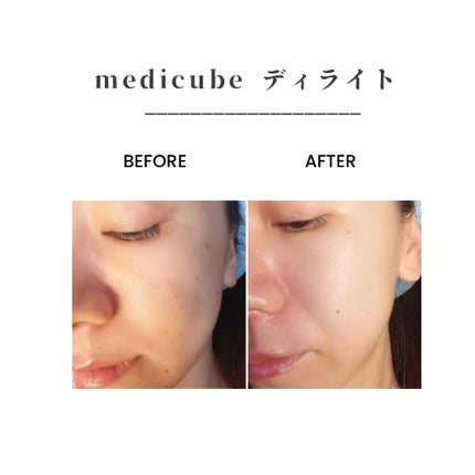 ゼロ毛穴パッド 2.0/MEDICUBE/トナーパッドを使ったクチコミ(9枚目)