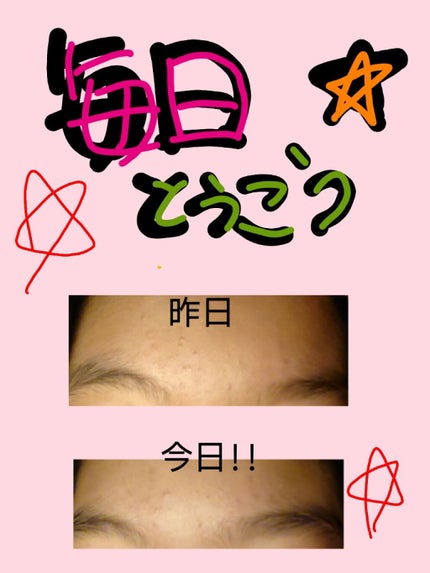 C1000 ビタミンレモンのクチコミ「遅くなりました!すいません!!!🙇🙏
ピカチュウ見てましたw♥🙇❤️
今日で、スキンケ.....」(1枚目)