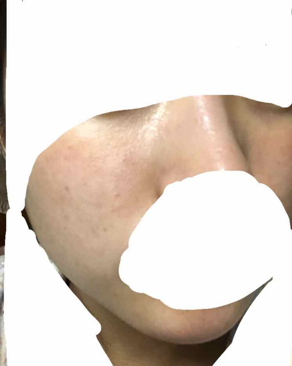 ぽたち on LIPS 「ベピオゲルの使用を中断して4日?ほど経ちました。とても!肌の!..」(1枚目)