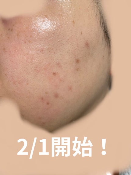 ニキビあとケアジェル/アットノン/その他スキンケアを使ったクチコミ(2枚目)