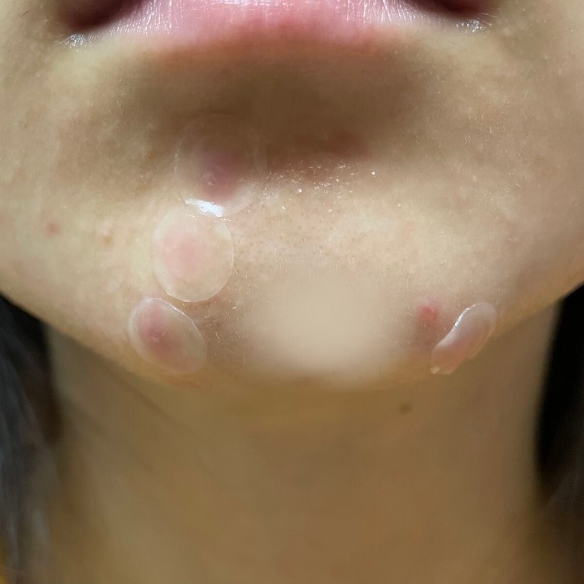 プロCICA クリアスポットパッチ/VT/その他スキンケアを使ったクチコミ(3枚目)