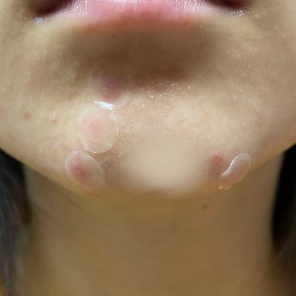 プロCICA クリアスポットパッチ/VT/その他スキンケアを使ったクチコミ(3枚目)