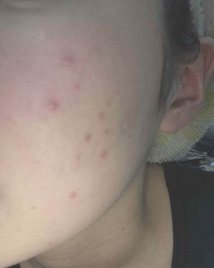 イハダ 薬用バーム【医薬部外品】/IHADA/フェイスバームを使ったクチコミ(3枚目)