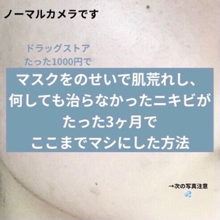 ペアアクネクリームW(医薬品)/ペア/その他を使ったクチコミ(1枚目)