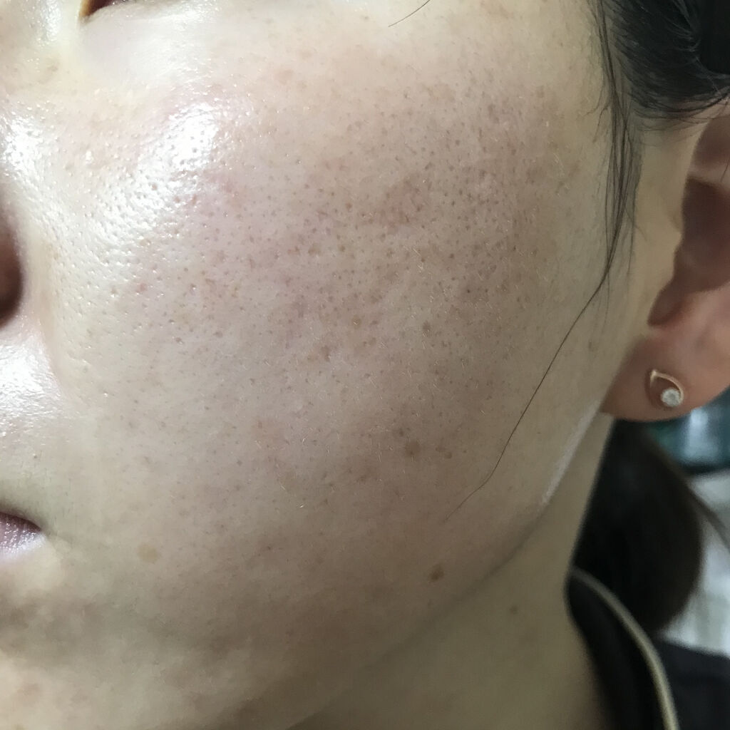 ゼロスポットパッチ/Today’s Cosme/にきびパッチを使ったクチコミ（2枚目）