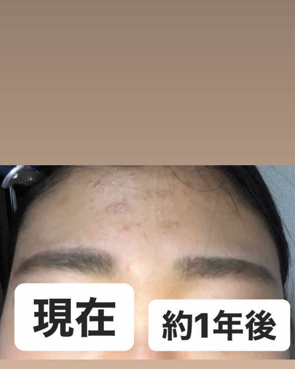 桃 on LIPS 「『⚠️ニキビの肌出てくるので閲覧注意⚠️』〜今に至るまで〜約1..」(4枚目)