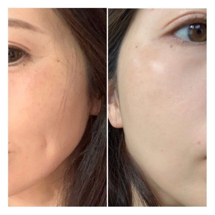 スキンケア/肌改善/yukari.Oka on LIPS 「ビフェイス化粧品で肌改善をされた方の実例をご紹介します◽︎シミ..」(7枚目)