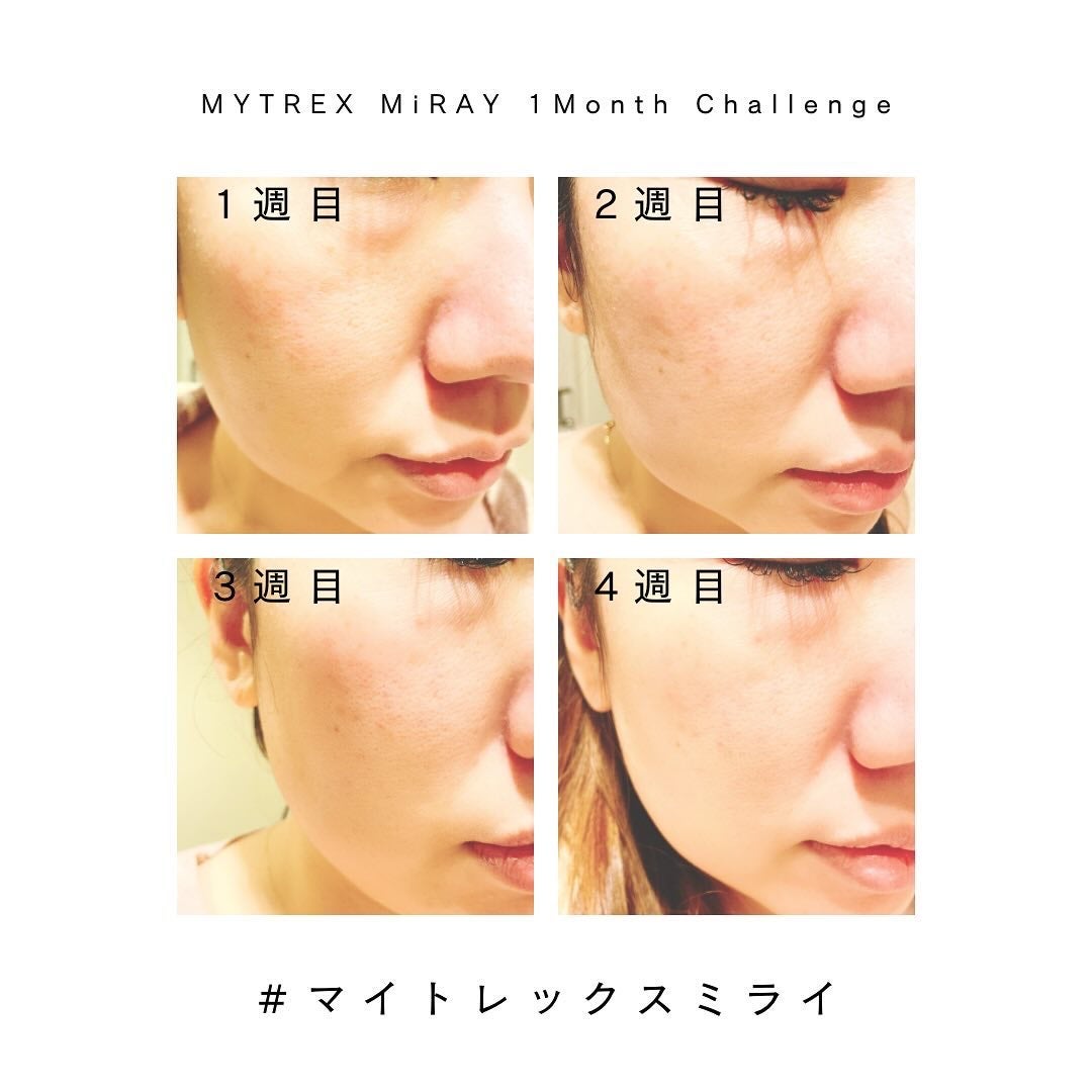 MiRAY/MYTREX/美顔器・マッサージを使ったクチコミ(2枚目)