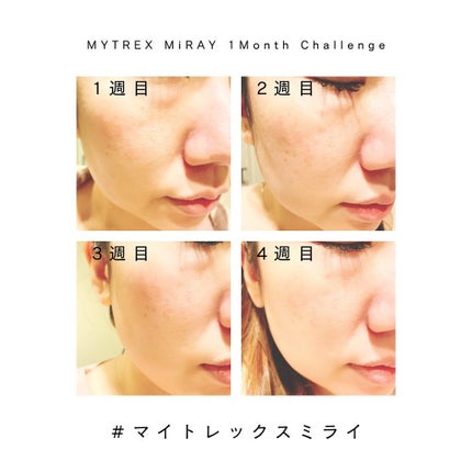 MiRAY/MYTREX/美顔器・マッサージを使ったクチコミ(2枚目)
