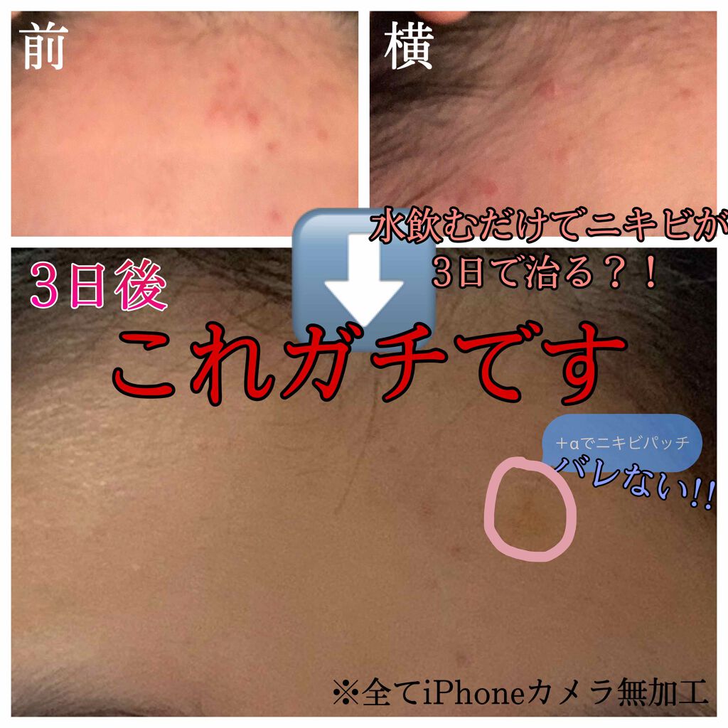 オロナインH軟膏 (医薬品)/オロナイン/その他を使ったクチコミ(1枚目)