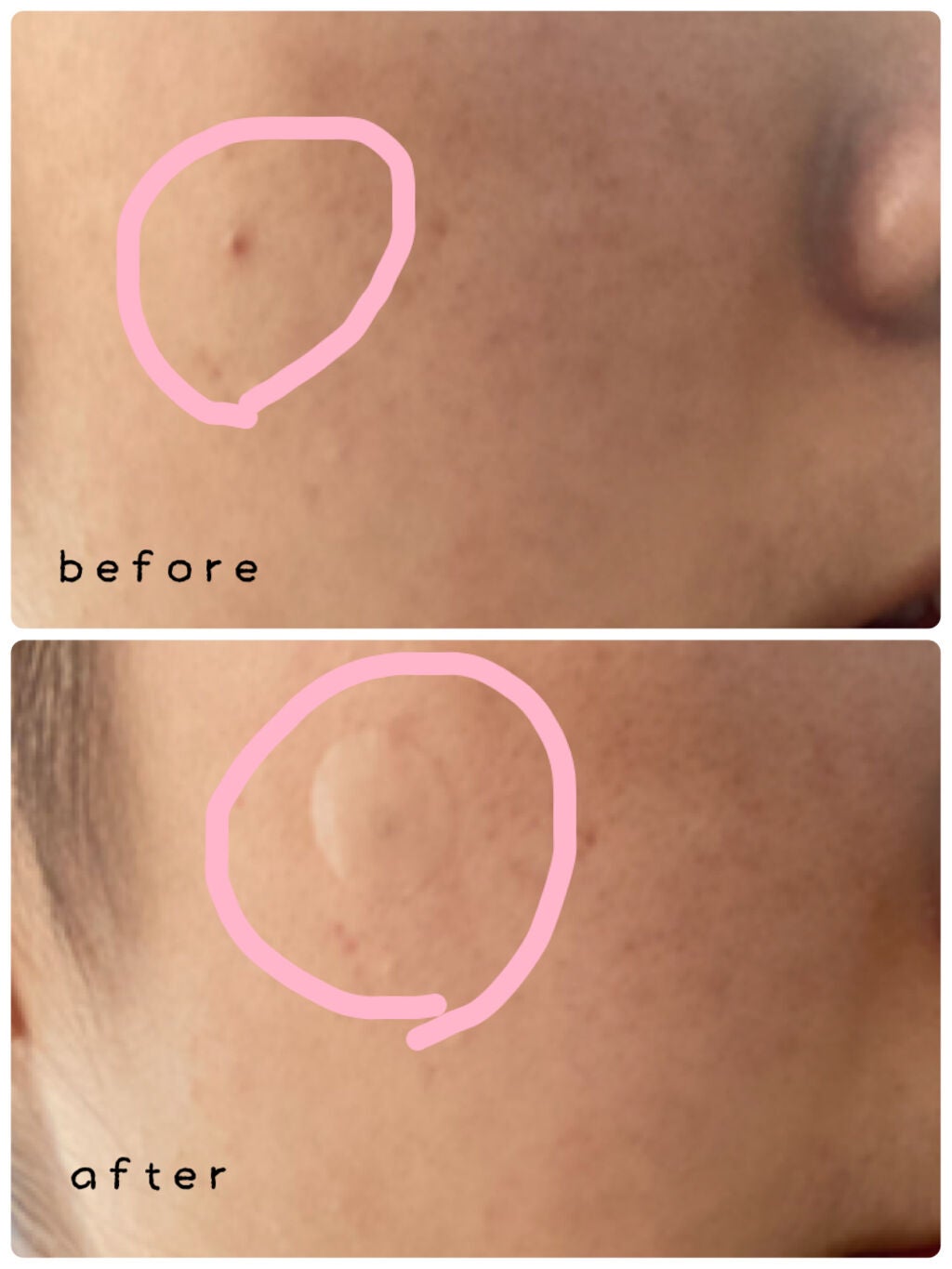 クリアパッチ/Angelab/にきびパッチを使ったクチコミ(3枚目)